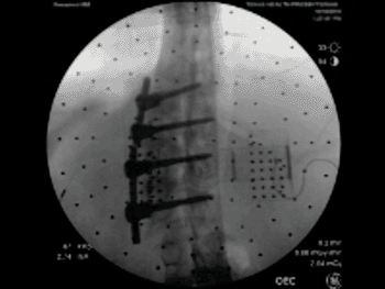 Image: Fluoroscopy image using the Renaissance C-OnSite software application (Photo courtesy of Mazor Robotics).